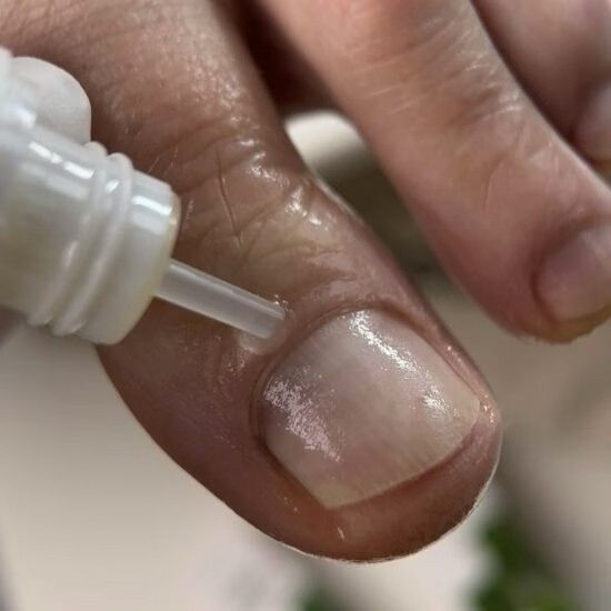 Олія від оніхолізису та грибка Onistopix Oil, 8 мл CR08 фото