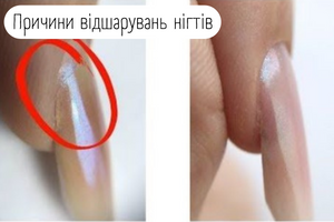 Причини відшарувань  фото