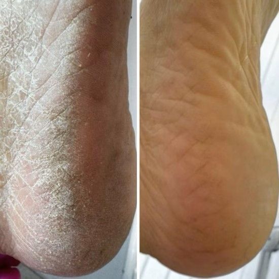 Крем від тріщин для рук та стоп Resultum Anti Crack Cream Jojoba з жожоба, 50 мл CR02 фото
