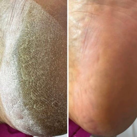 Крем від тріщин для рук та стоп Resultum Anti Crack Cream Jojoba з жожоба, 50 мл CR02 фото